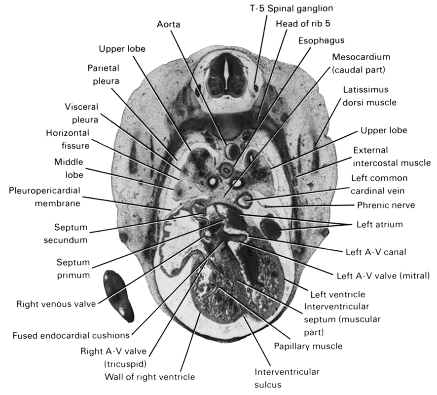 T-5 spinal ganglion, aorta, esophagus, external intercostal muscle(s), fused endocardial cushions, head of rib 5, horizontal fissure, interventricular septum (muscular part), interventricular sulcus, latissimus dorsi muscle, left atrioventricular (mitral) valve, left atrioventricular canal, left atrium, left common cardinal vein, left ventricle, mesocardium (caudal part), middle lobe, papillary muscle, parietal pleura, phrenic nerve, pleuropericardial membrane, right atrioventricular (tricuspid) valve, right venous valve, septum primum, septum secundum, upper lobe, visceral pleura, wall of right ventricle