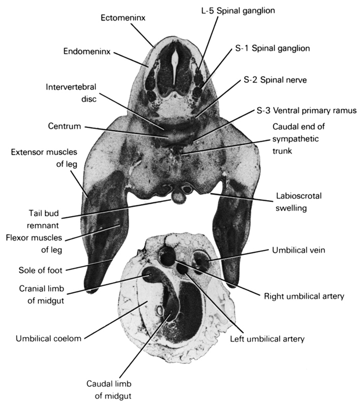 L-5 spinal ganglion, S-1 spinal ganglion, S-2 spinal nerve, S-3 ventral primary ramus, caudal end of sympathetic trunk, caudal limb of midgut, centrum, cranial limb of midgut, ectomeninx, endomeninx, extensor muscles of leg, flexor muscles of leg, intervertebral disc, labioscrotal swelling, left umbilical artery, right umbilical artery, sole of foot, tail bud remnant, umbilical coelom, umbilical vein