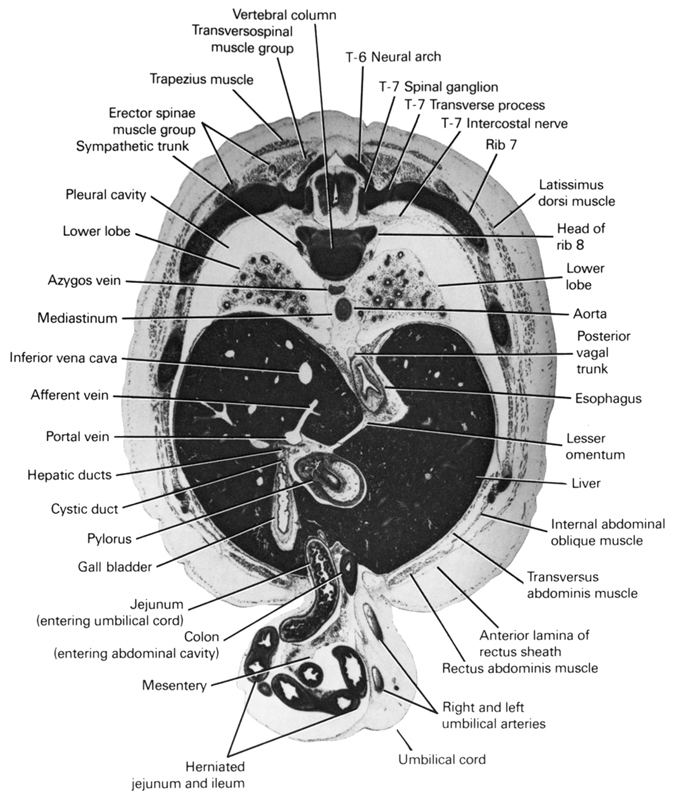 T-6 neural arch, T-7 intercostal nerve, T-7 spinal ganglion, T-7 transverse process, afferent vein, anterior lamina of rectus sheath, aorta, azygos vein, colon (entering abdominal cavity), cystic duct, erector spinae muscle group, esophagus, gall bladder, head of rib 8, hepatic duct(s), herniated jejunum and ileum, inferior vena cava, internal abdominal oblique muscle, jejunum (entering umbilical cord), latissimus dorsi muscle, lesser omentum, liver, lower lobe, mediastinum, mesentery, pleural cavity, portal vein, posterior vagal trunk, pylorus, rectus abdominis muscle, rib 7, right and left umbilical arteries, sympathetic trunk, transversospinalis muscle group, transversus abdominis muscle, trapezius muscle, umbilical cord, vertebral column