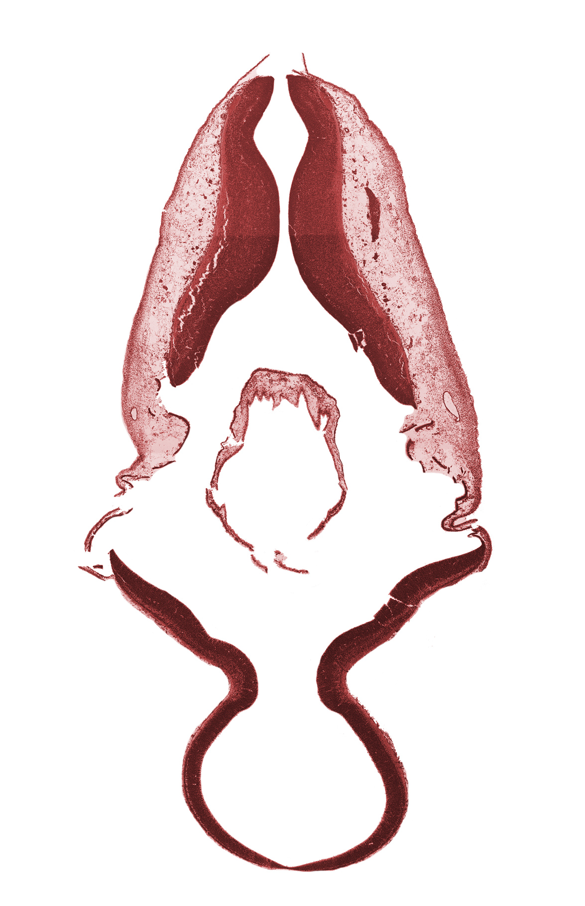 accessory nerve (CN XI), disrupted tissue (artifact), missing tissue (artifact), tissue fracture (artifact)