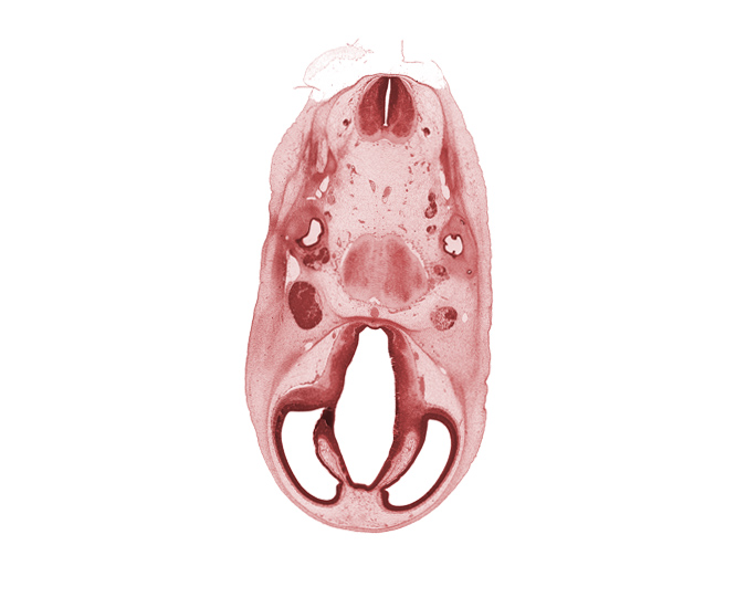 accessory nerve (CN XI), anterior semicircular duct, artifact separation(s), basilar artery, hippocampal thickening, hypothalamus, left vertebral artery, pons region (metencephalon), right vertebral artery, roof of diencephalon, root of abducens nerve (CN VI), root of trigeminal nerve (CN V), spinal accessory nerve (CN XI), subarachnoid space, superior ganglion of glossopharyngeal nerve (CN IX), superior ganglion of vagus nerve (CN X), transition region, trigeminal ganglion (CN V)