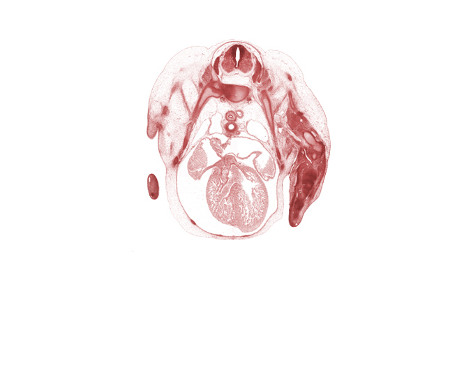 T-1 / T-2 intervertebral disc, T-1 intercostal nerve, T-1 spinal ganglion, T-2 intercostal nerve, T-2 spinal ganglion, axillary artery, brachial plexus, interventricular foramen, left atrium, left ventricle, muscular part of interventricular septum, phrenic nerve, rib 2, rib 3, rib 4, right atrium, right precardinal vein, right pulmonary artery, right vagus nerve (CN X), right ventricle, subarachnoid space, sulcus limitans, undivided truncus arteriosus (proximal outflow tract)