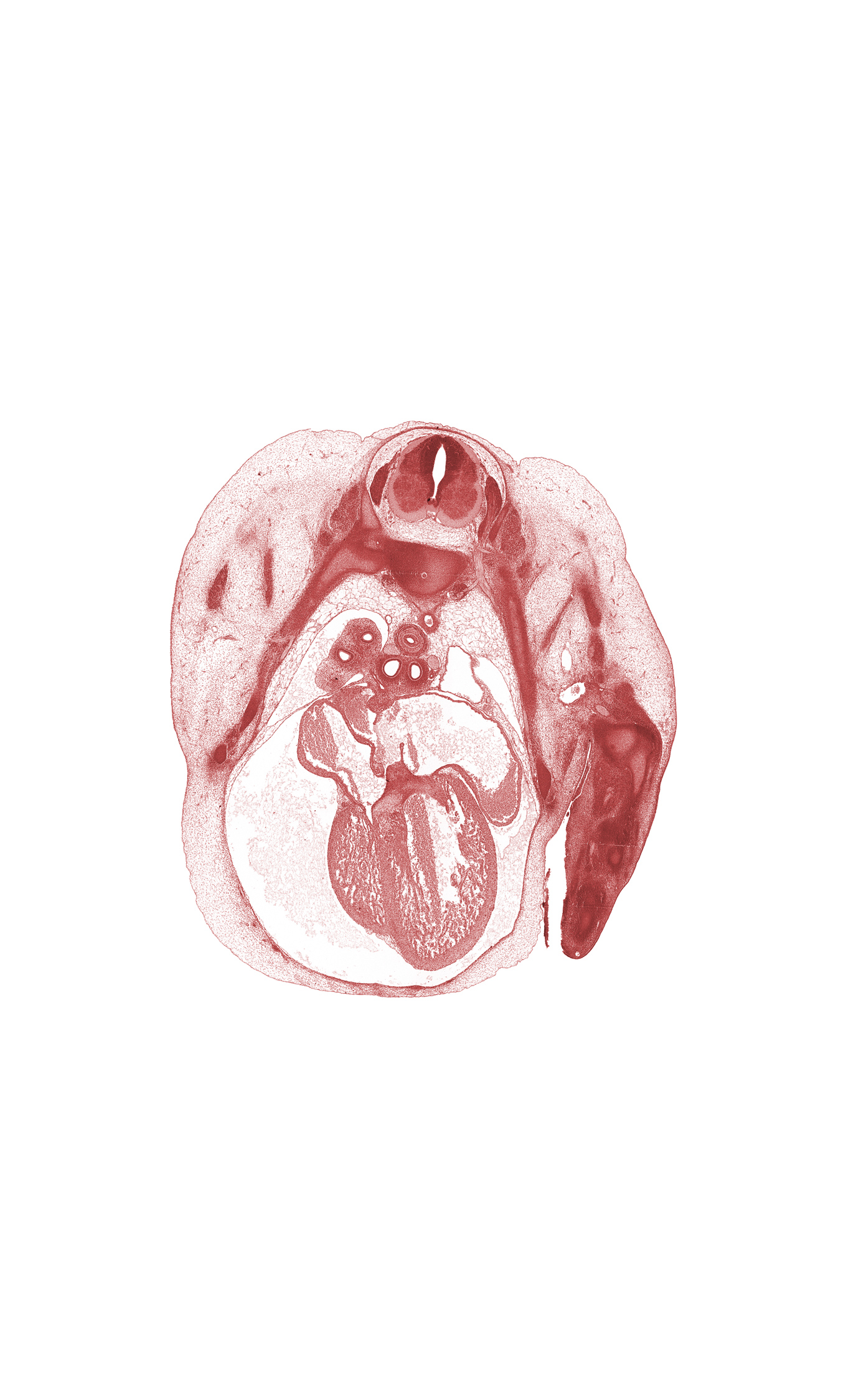 T-2 / T-3 intervertebral disc, T-2 intercostal nerve, T-2 spinal nerve, T-3 spinal ganglion, artifact separation(s), communicating ramus, edge of pleural cavity, interventricular sulcus, left horn of sinus venosus, left primary bronchus, left ventricle, pericardial cavity, pleural cavity, primary interatrial septum (septum primum) remnant, rib 3, rib 4, right atrioventricular canal, right atrium, right primary bronchus, right vagus nerve (CN X), right ventricle, secondary interatrial foramen (foramen secundum), sinus venosus, sympathetic trunk