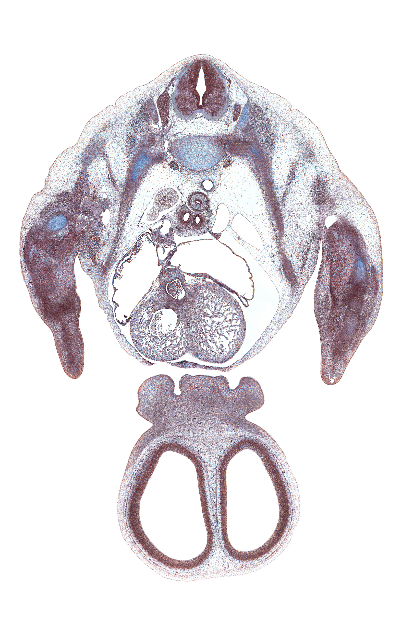 T-3 spinal ganglion, aorta, aortic vestibule, apex of right lung, artifact(s), azygos vein, cerebral vesicle (telencephalon), dorsal horn of grey matter, falx cerebri region, interorbital groove, interorbital ligament, lateral nasal prominence, lateral ventricle, left atrium, left precardinal vein, left primary bronchus, medial nasal prominence(s), naris, neural arch, neural canal, phrenic nerve, pleural cavity, rib 3, right atrium, right primary bronchus, serratus anterior muscle, superior hemi-azygos vein, superior vena cava, sympathetic trunk, trabecular part of left ventricle, trabecular part of right ventricle, ventral horn of grey matter