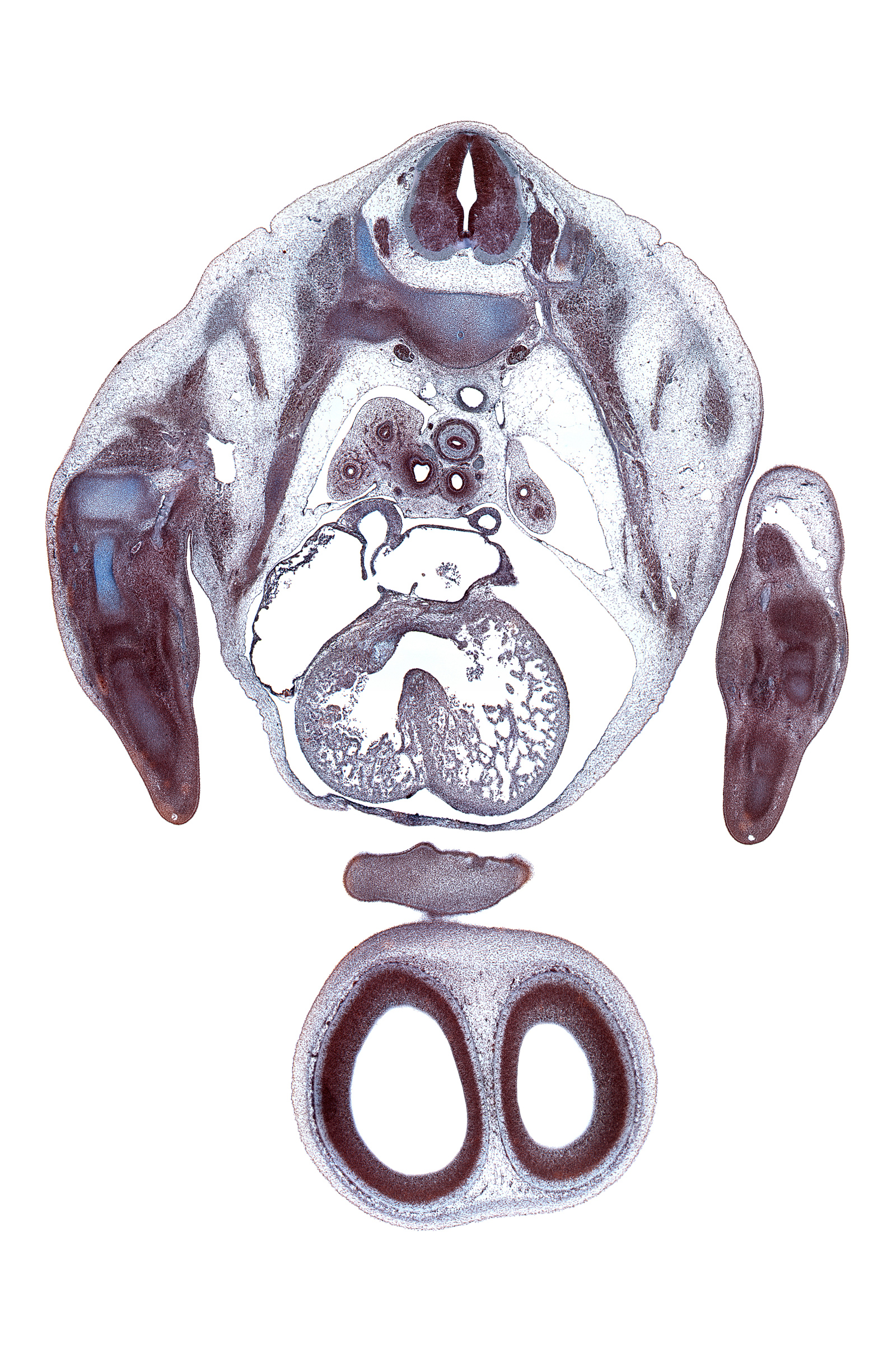 T-3 dorsal primary ramus, T-3 intercostal nerve, T-3 spinal ganglion, T-3 ventral primary ramus, azygos vein, cerebral vesicle (telencephalon), edge of upper lip, forearm, frontal prominence, heart prominence, interventricular foramen, lateral ventricle, left atrium, left ventricle, pericardial cavity, phrenic nerve, primary interatrial septum (septum primum), pulmogenic mesenchyme, radius, right atrium, secondary interatrial foramen (foramen secundum), serratus anterior muscle, subarachnoid space, superior vena cava, sympathetic trunk, upper lobe of left lung, upper lobe of right lung