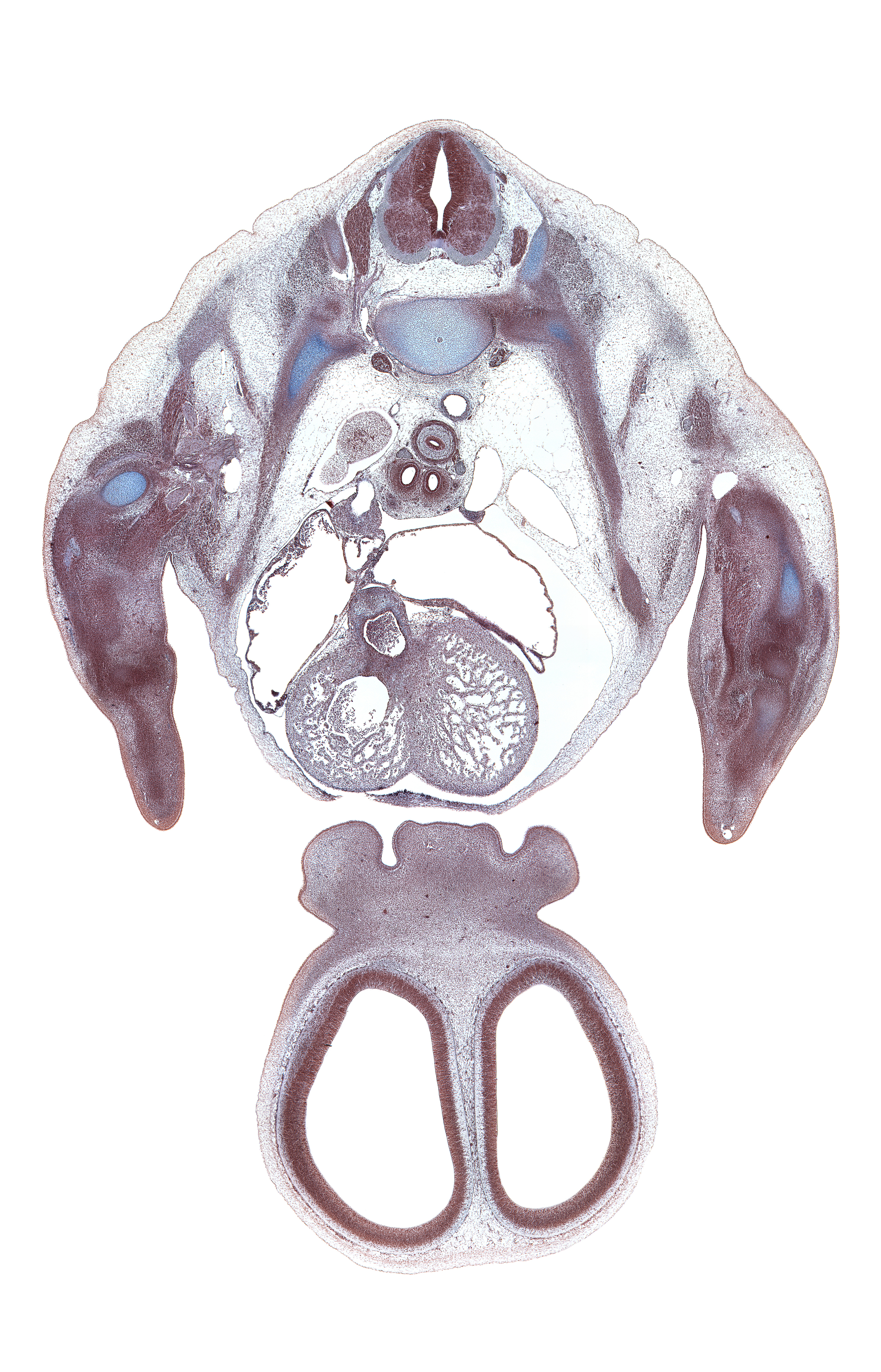 T-3 spinal ganglion, aorta, aortic vestibule, apex of right lung, artifact(s), azygos vein, cerebral vesicle (telencephalon), dorsal horn of grey matter, falx cerebri region, interorbital groove, interorbital ligament, lateral nasal prominence, lateral ventricle, left atrium, left precardinal vein, left primary bronchus, medial nasal prominence(s), naris, neural arch, neural canal, phrenic nerve, pleural cavity, rib 3, right atrium, right primary bronchus, serratus anterior muscle, superior hemi-azygos vein, superior vena cava, sympathetic trunk, trabecular part of left ventricle, trabecular part of right ventricle, ventral horn of grey matter