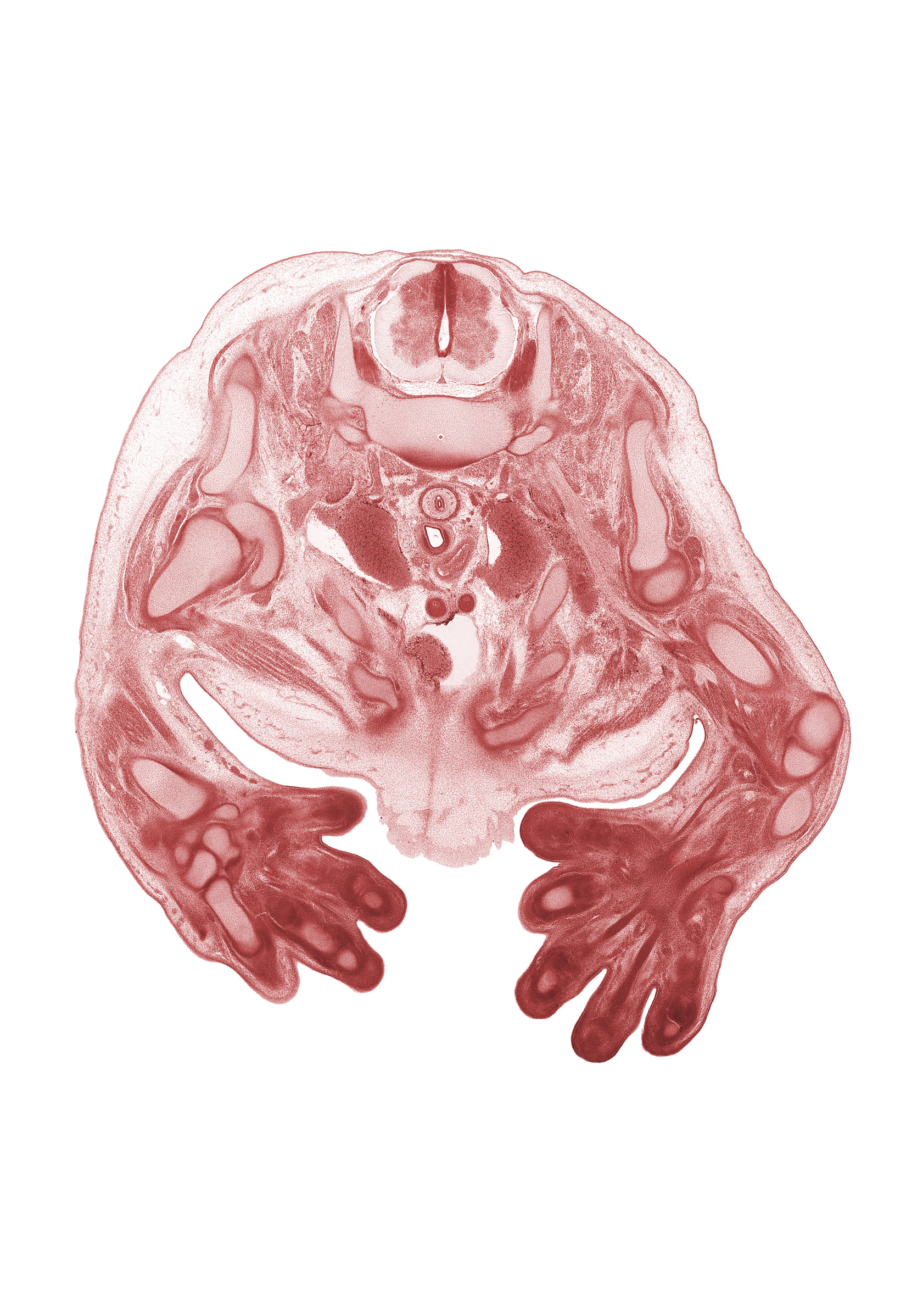 C-8 spinal ganglion, C-8 spinal nerve, anterior scalene muscle, arch of aorta, axillary vein, brachial artery, cephalic edge of right atrium, deltoid muscle, digit 1 (thumb), digit 4 (ring finger), flexor digitorum tendon in palm region, glenohumeral joint, humerus, lateral cord of brachial plexus, median nerve, middle scalene muscle, pectoralis major muscle, pericardial cavity, radiohumeral joint, radius, rib 1, right brachiocephalic vein, scapula, trapezius muscle, ulna