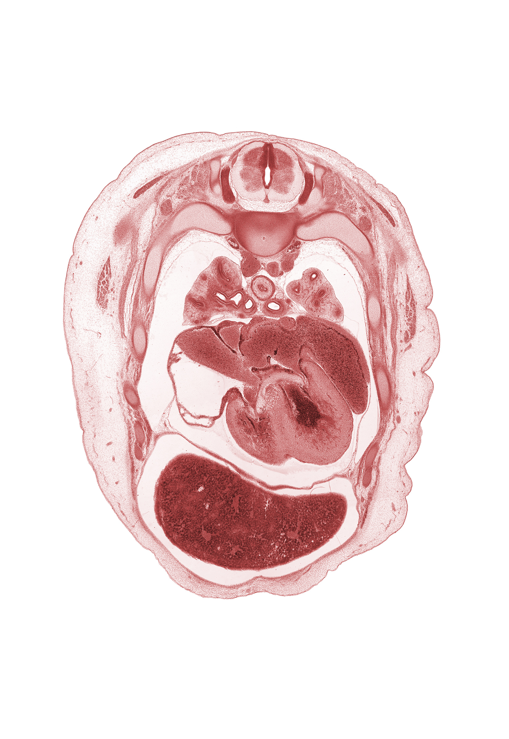 T-3 spinal ganglion, apical segmental bronchus, atrioventricular sulcus, azygos vein, edge of scapula, interventricular sulcus, left atrium, left lobe of liver, left vagus nerve (CN X), left ventricle, muscular part of interventricular septum, phrenic nerve, pleural cavity, primary bronchus, rib 4, rib 5, right atrioventricular (tricuspid) valve, right atrium, right lobe of liver, serratus anterior muscle, sinus venosus, superior hemi-azygos vein, upper lobe of left lung, upper lobe of right lung, upper secondary bronchus