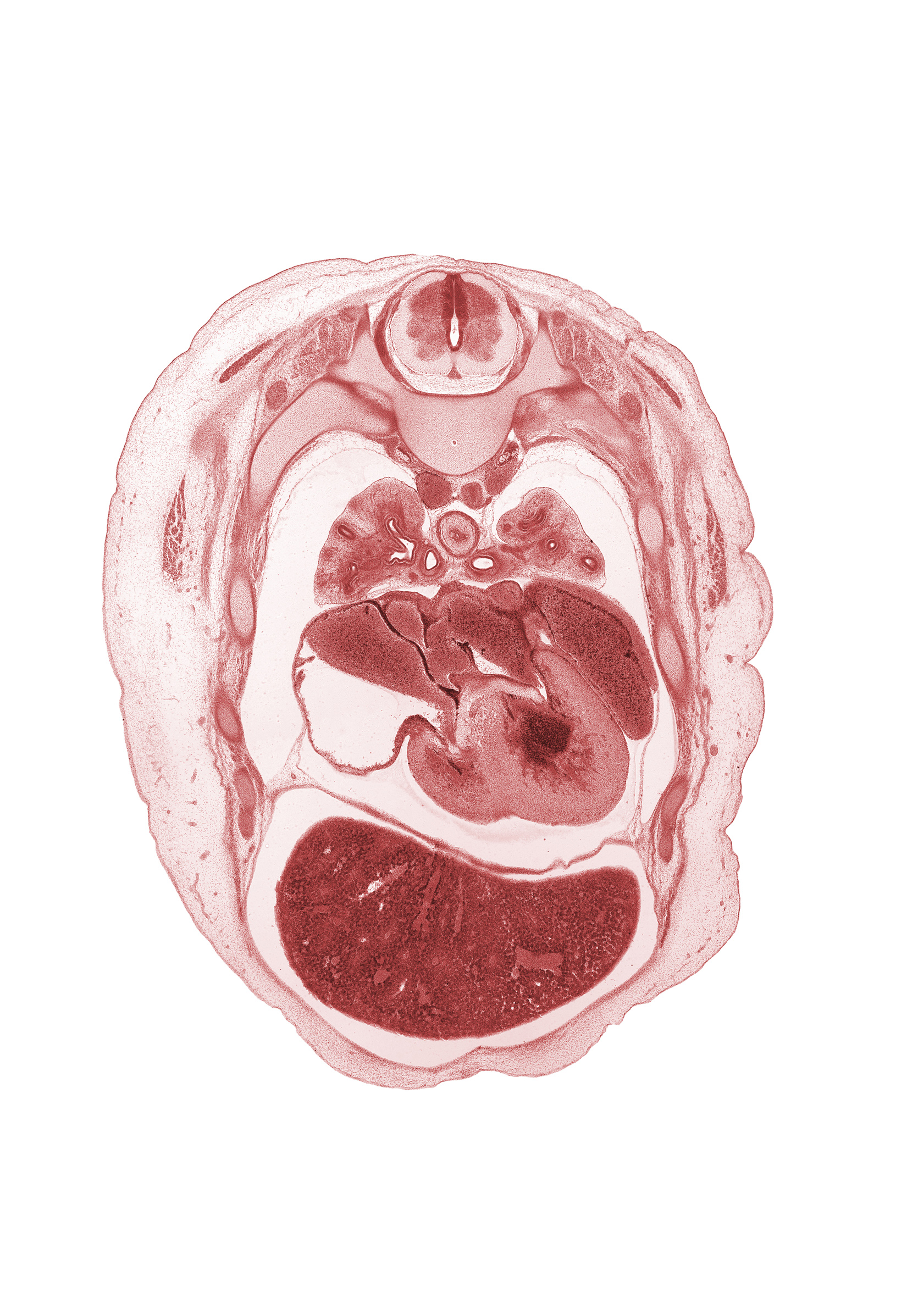 T-3 / T-4 interganglion region, anterior segmental bronchus, apical segmental bronchus, azygos vein, interventricular sulcus, left atrioventricular (mitral) valve, left atrium, left ventricle, muscular part of interventricular septum, phrenic nerve, posterior segmental bronchus, primary bronchus, rib 5, right atrioventricular (tricuspid) valve, right atrium, right ventricle, sinus venosus, superior hemi-azygos vein, upper lobe of left lung, upper lobe of right lung