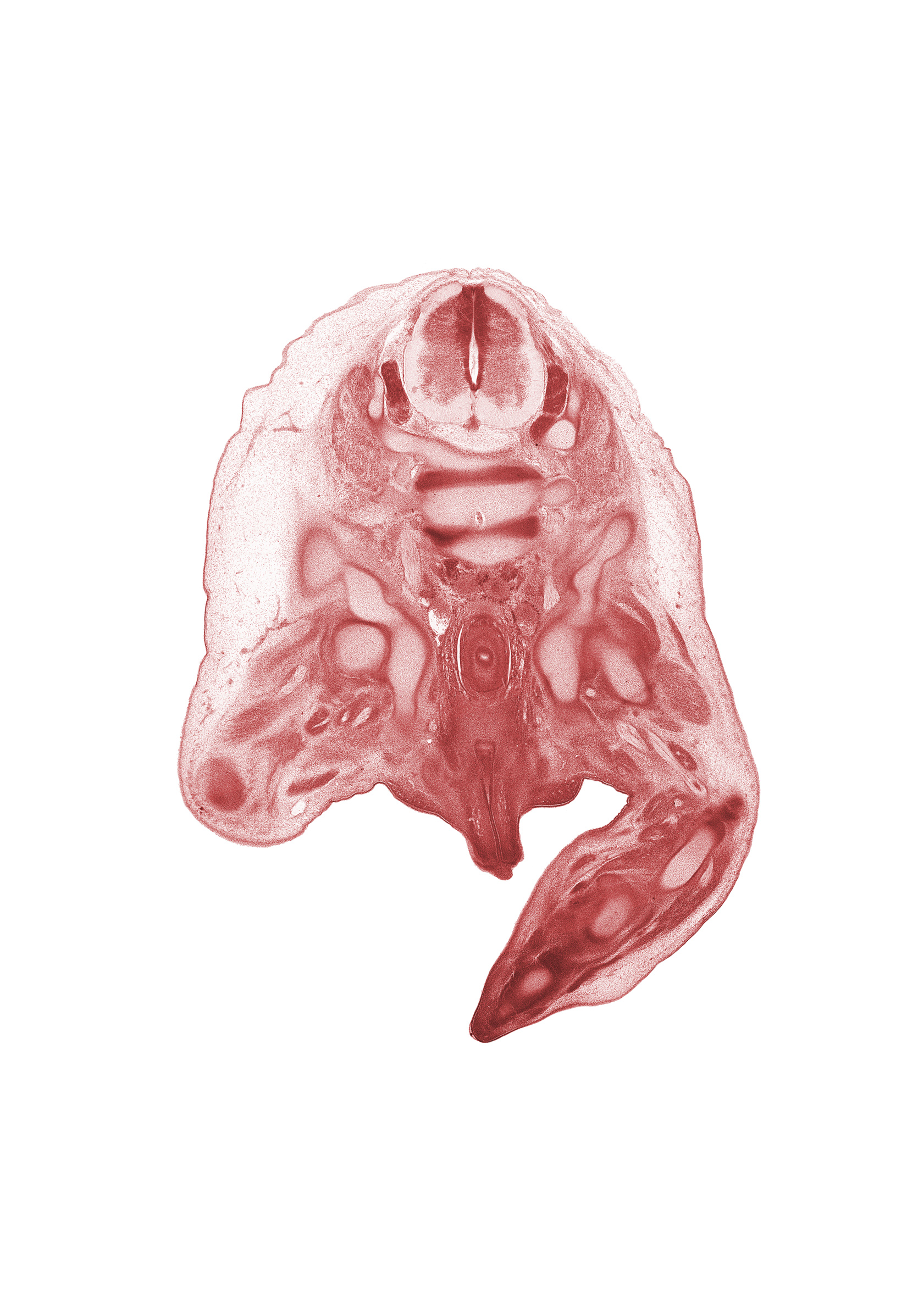 L-4 / L-5 intervertebral disc, L-4 spinal ganglion, L-4 spinal nerve, L-5 / S-1 intervertebral disc, L-5 spinal ganglion, L-5 spinal nerve, centrum of L-5 vertebra, centrum of S-1 vertebra (cephalic edge of sacrum), common fibular nerve, femur, fibula, glans penis, ilium, ischium, rectum, scrotal swelling, tibial nerve, urethra