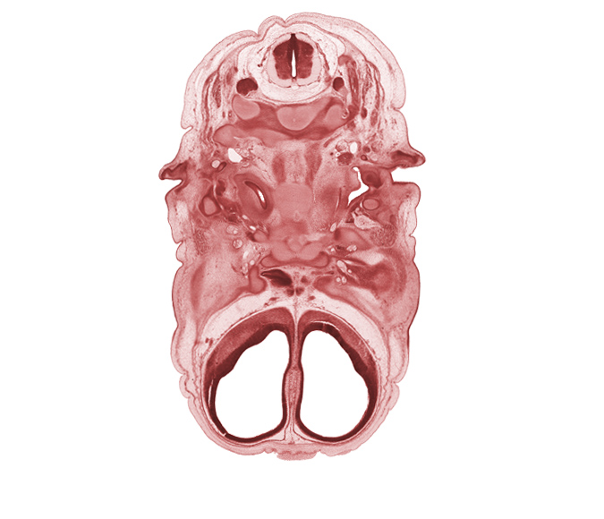 C-2 spinal ganglion, C-2 spinal nerve, artifact fracture(s), artifact separation(s), auricle, body of sphenoid, cephalic edge of diencephalon, falx cerebri region, inferior ganglion of glossopharyngeal nerve (CN IX), longus capitis muscle, mandibular nerve (CN V₃), maxillary nerve (CN V₂), ophthalmic nerve (CN V₁), optic nerve (CN II), pharyngeal arch 1 cartilage (Meckel), sympathetic trunk, venous plexus(es)