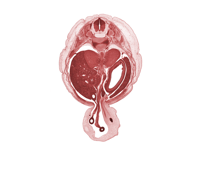 T-11 spinal ganglion, T-11 spinal nerve, aorta, body of stomach, distal limb of midgut, duodenum, external abdominal oblique muscle, internal abdominal oblique muscle, left lobe of liver, neural arch, proximal limb of herniated midgut, rectus abdominis muscle, superior mesenteric artery, superior mesenteric vessels, transversus abdominis muscle