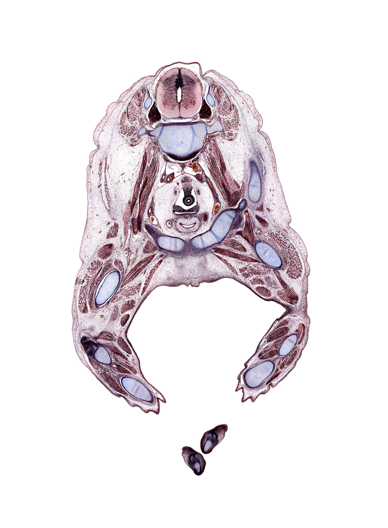 L-3 spinal ganglion, cephalic edge of scrotal swelling, common fibular nerve, distal phalynx of left digit 1 (foot), distal phalynx of right digit 1 (foot), dorsal horn of grey matter, external iliac artery, femoral nerve, fibula, flexor digitorum longus muscle, flexor hallucis longus muscle, gracilis muscle, iliocostalis muscle, ilium, psoas major muscle, semimembranosus muscle, semitendinosus muscle, superior pubic ramus, tibia, tibial nerve, ureter, urinary bladder, vastus lateralis muscle, ventral horn of grey matter