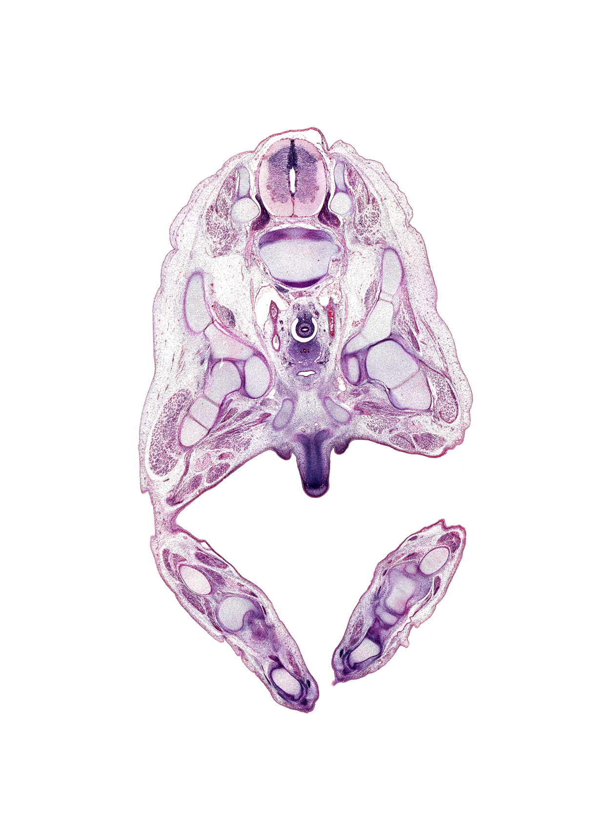 L-4 / L-5 intervertebral disc, L-4 spinal ganglion, L-5 / L-6 intervertebral disc, calcaneal tendon, corpus cavernosum, crus of penis, dorsal funiculus, extensor hallucis longus tendon, fibula, flexor hallucis brevis muscle, flexor hallucis longus muscle, flexor hallucis longus tendon, fused paramesonephric ducts, gastrocnemius muscle, glans penis, hip joint, iliacus muscle, inferior pubic ramus, lateral funiculus, ligament of head of femur, medial malleolus of tibia, median sacral artery, mesonephric duct, metatarsal 1, navicular, obturator nerve, right umbilical artery, sciatic nerve, scrotal swelling, talus, tibia, tibial nerve, ventral funiculus