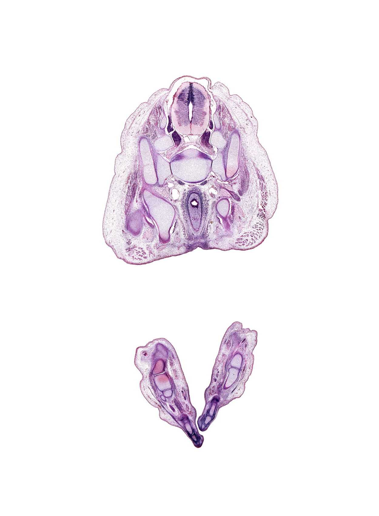 L-5 spinal ganglion, S-1 / S-2 intervertebral region, S-1 spinal ganglion, S-1 ventral primary ramus, anal pit, anal sphincter, calcaneum, cuboid, dorsal interosseus muscle, dorsum of foot, dura mater, extensor digitorum brevis muscle, extensor digitorum longus tendon, gluteus maximus muscle, ilium, ischial tuberosity, lateral plantar nerve, left common iliac vein, metatarsal 4, metatarsal 4 base, pelvic ganglia, plantar side of foot, rectum, sacral plexus, sacro-iliac joint, subarachnoid space