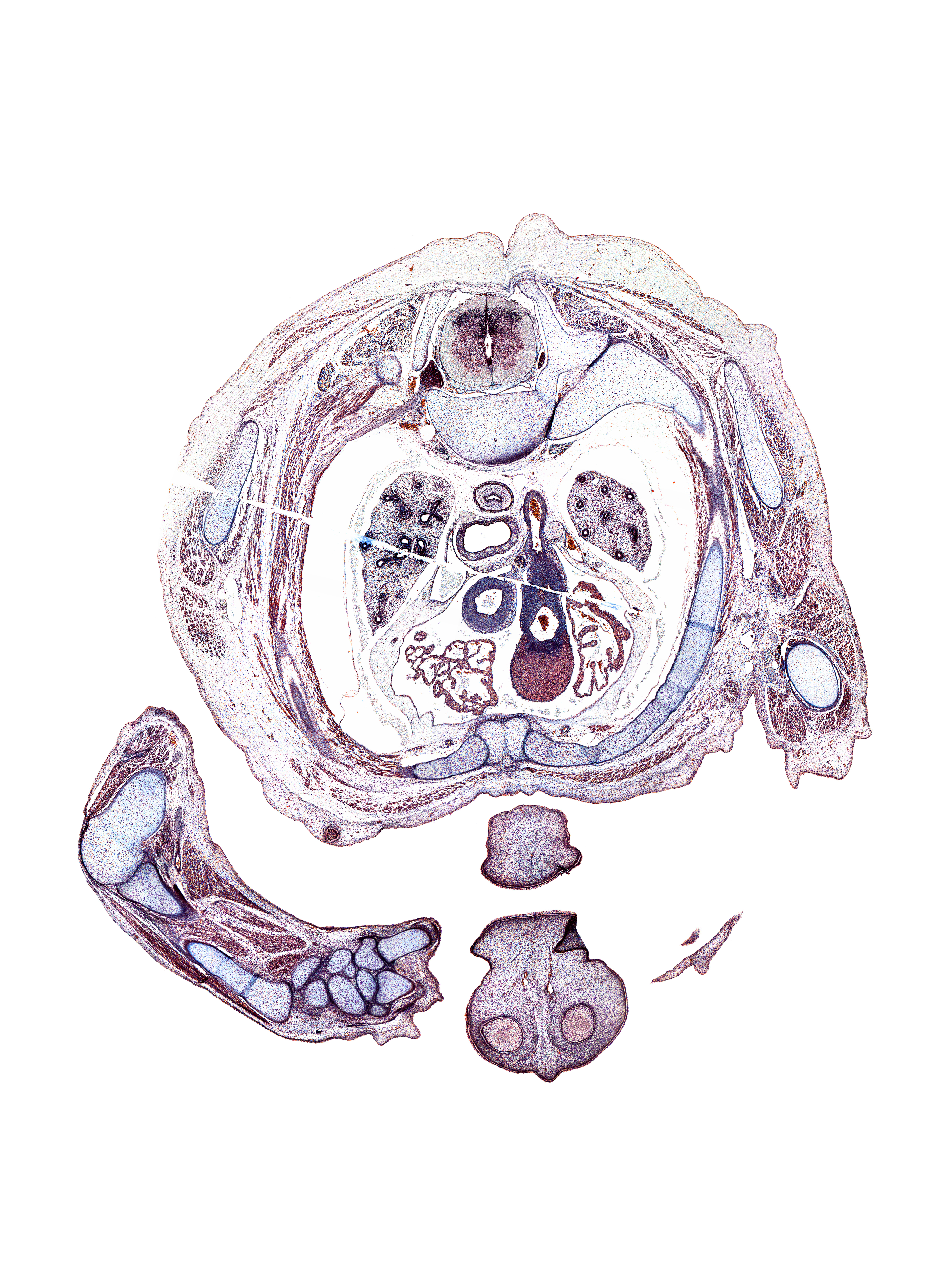 T-3 spinal ganglion, artifact(s), capitulum of humerus, cephalic edge of left hand, head of radius, lunate, mammary gland, metacarpal 1, metacarpal 2, middle part of upper lip, pectoralis major muscle, radiohumeral joint, radius, rib 3, scaphoid, scapula, subarachnoid space, superior vena cava, transverse process, trapezium, trapezius muscle, trapezoid, ulna