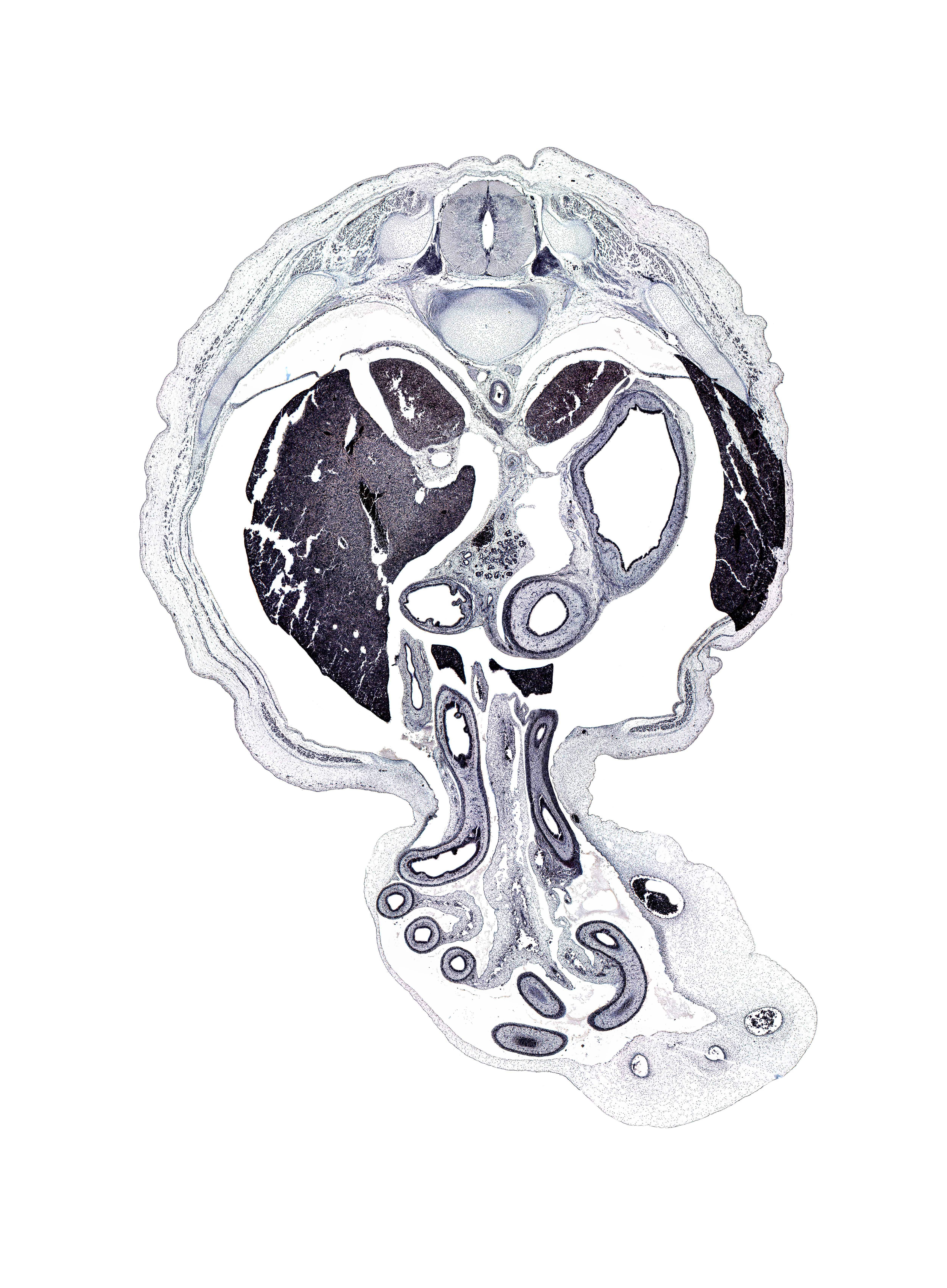 T-11 intercostal nerve, T-11 spinal ganglion, artifact(s), costodiaphragmatic recess, distal limb of herniated midgut, dorsal mesogastrium, hindgut, iliocostalis muscle, lesser curvature of stomach, lesser sac (omental bursa), longissimus muscle, lumen of body of stomach, mesentery, multifidus muscle, muscular part of diaphragm, proximal limb of herniated midgut, rib 11, right lobe of liver, right umbilical artery, spinalis muscle, umbilical coelom, umbilical vein