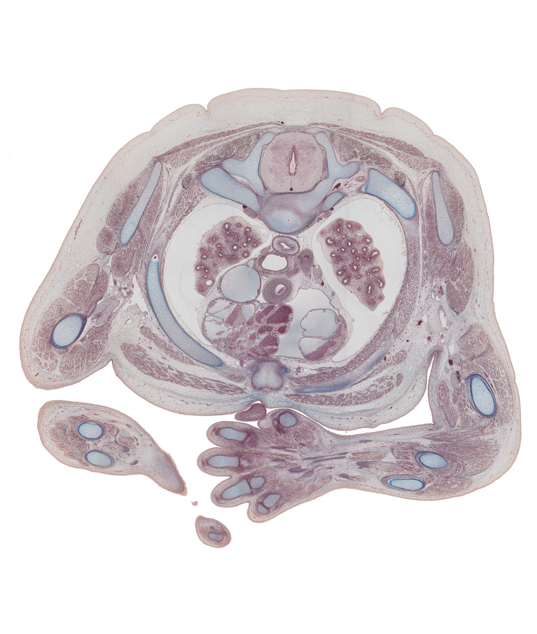 T-2 / T-3 intervertebral disc, T-3 spinal ganglion, anterior spinal artery, axillary lymph sac, carpal tunnel, cephalic edge of rib 3 (costal cartilage), humerus, hypothenar muscle, left atrium, median nerve, metacarpophalangeal joint of digit 4 (ring finger), pectoralis major muscle, pectoralis minor muscle, pleural cavity, radius, rhomboid major muscle, rib 3, right atrium, right phrenic nerve, serratus anterior muscle, sternal angle, subscapularis muscle, supraspinatus muscle, thenar muscle, trapezius muscle, triceps brachii muscle, ulna, ulnar artery, ventricular zone