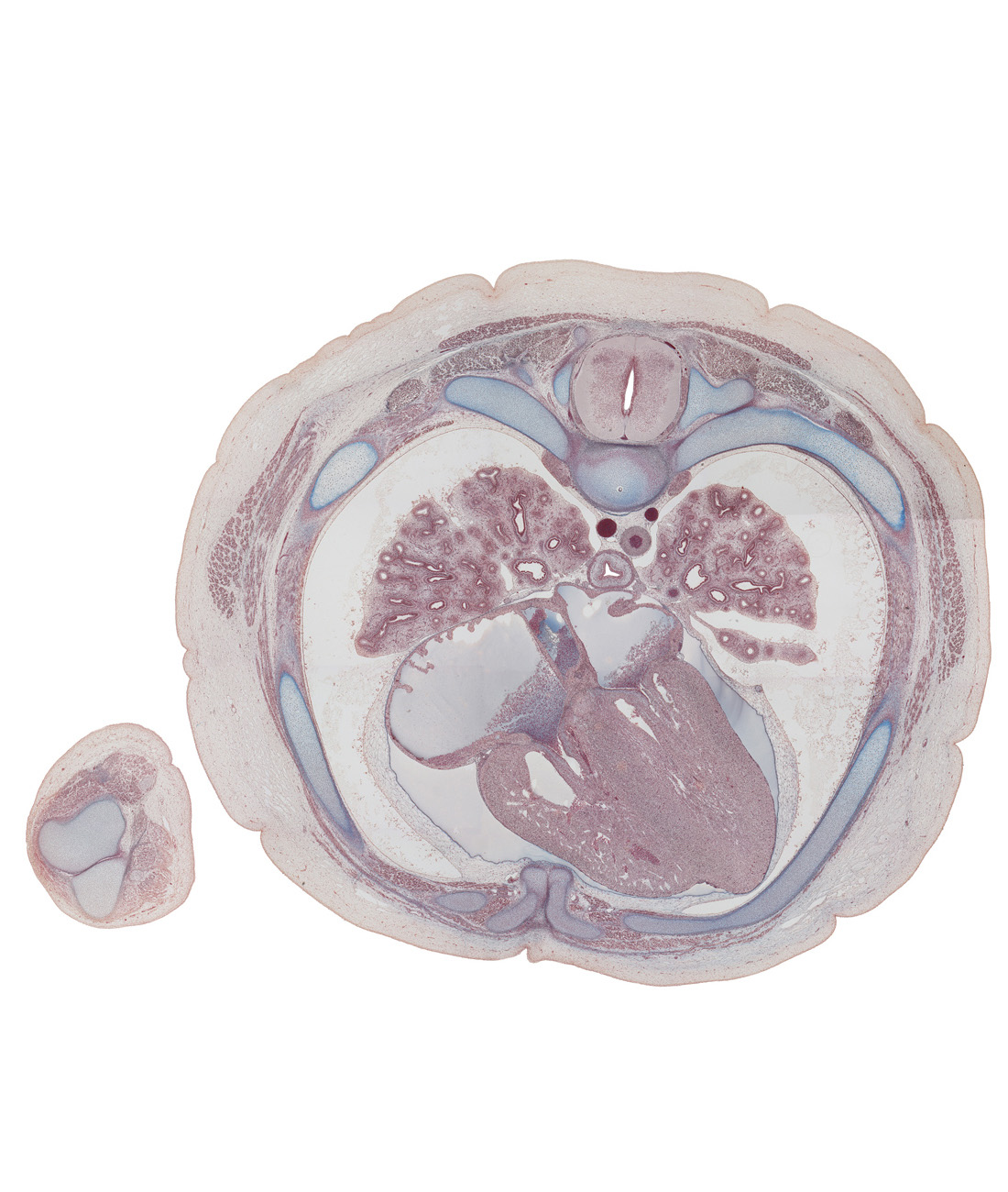 T-5 / T-6 interganglion region, T-5 / T-6 intervertebral disc, anterior interventricular sulcus, anterior papillary muscle in right ventricle, aorta, atrioventricular sulcus, dorsal funiculus, edge of lingula of upper lobe of left lung, esophagus, interatrial septum, lateral funiculus, left atrioventricular (mitral) valve, left phrenic nerve, lower lobe of left lung, lower lobe of right lung, middle lobe of right lung, pericardial cavity, pericardial sac, rib 5, rib 6, rib 6 (costal cartilage), right atrioventricular (tricuspid) valve opening, right lower pulmonary vein, ventral funiculus