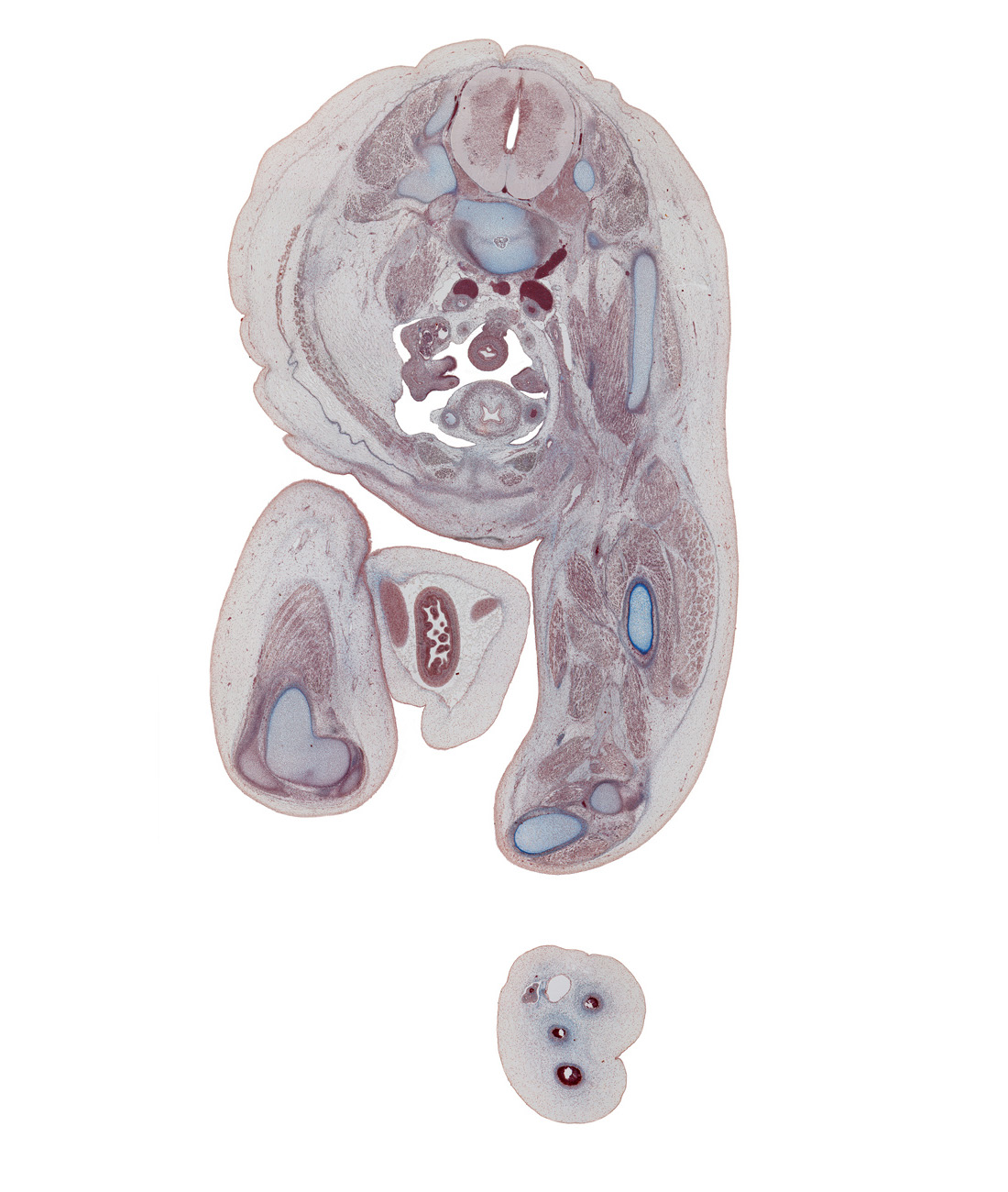 L-4 spinal ganglion, L-4 spinal nerve, adductor longus muscle, adductor magnus muscle, biceps femoris muscle, common fibular nerve, external abdominal oblique muscle, external iliac artery, femoral artery, femoral nerve, femur, gracilis muscle, gubernaculum of testis, head of fibula, herniated intestines, iliacus muscle, inferior epigastric artery, internal abdominal oblique muscle, lateral head of gastrocnemius muscle, left common iliac artery, left common iliac vein, medial head of gastrocnemius muscle, mesosigmoid, opening of paramesonephric duct, popliteus muscle, psoas major muscle, pyramidalis muscle, rectus abdominis muscle, right common iliac artery, sciatic nerve, semimembranosus muscle, semitendinosus tendon, sigmoid colon, tibia, tibial nerve, transversus abdominis muscle, umbilical coelom, umbilical cord, ureter, vas deferens