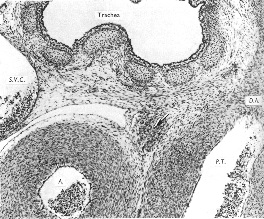 The caudal portion of the aorticopulmonary ganglion