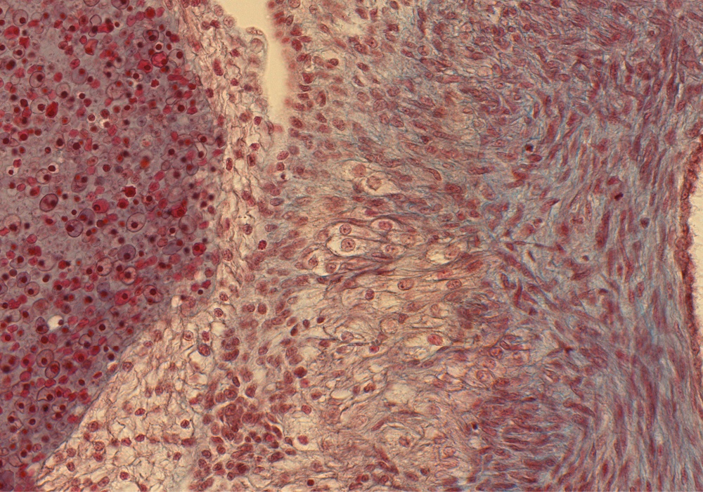 Pulmonary A. Wall and Rt. Ventricle Wall