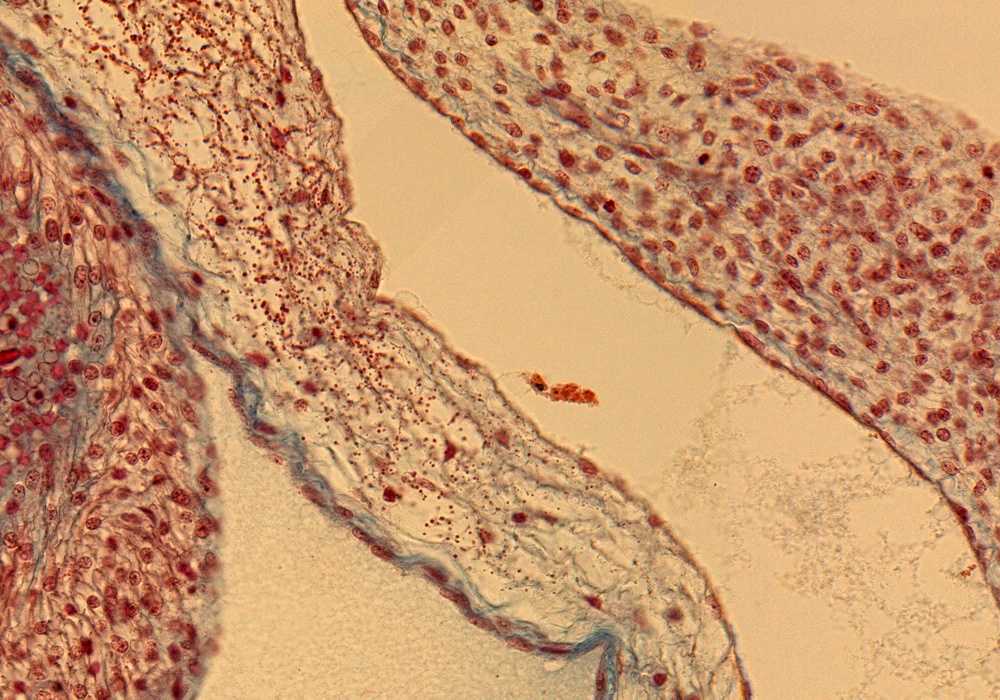 Lt. Atrium Wall and Pericardial Sac