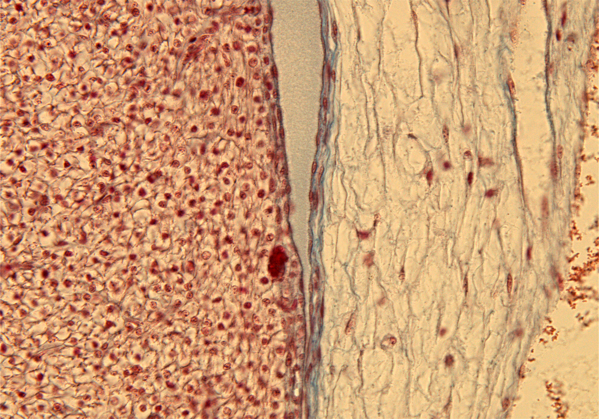 Lt. Ventricle Wall