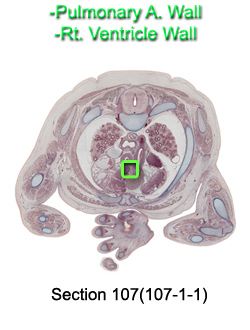 Pulmonary A. Wall and Rt. Ventricle Wall