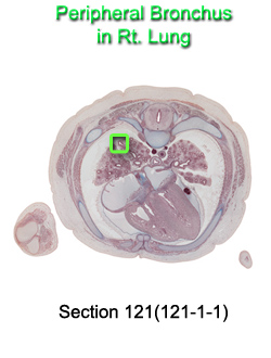 Peripheral Bronchus in Rt. Lung