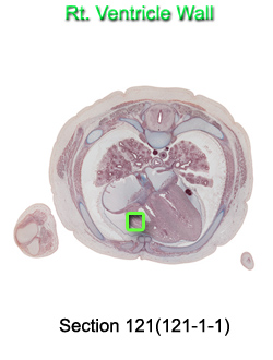 Rt. Ventricle Wall