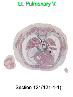 Lt. Pulmonary V.