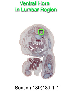 Ventricular Horn in Lumbar Region