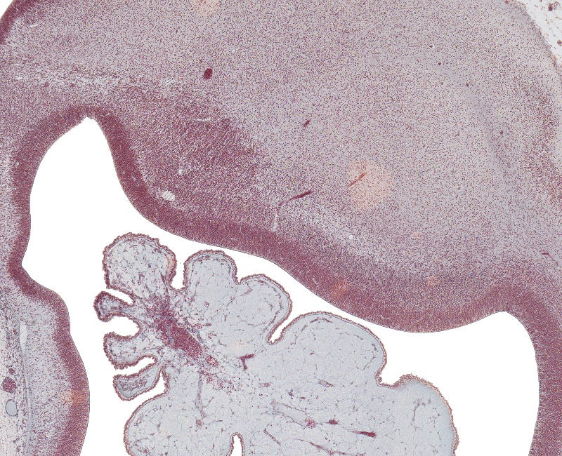 Med. and Lat. Eminence in Lateral Ventricle