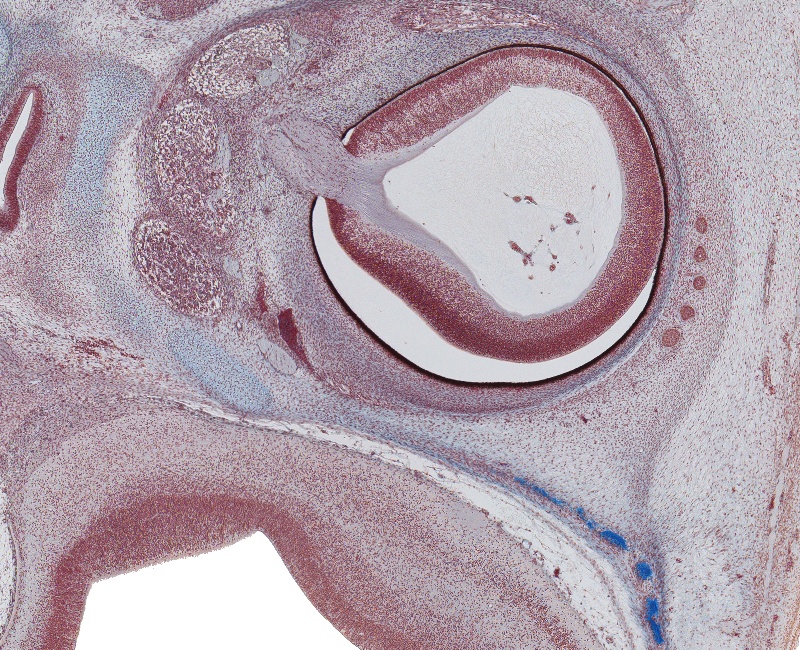 Middle of Orbit and Olfactory Part of Cerebral Hemisphere