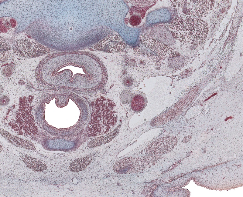 Thyroid Gland and Cartoid Sheath Structures