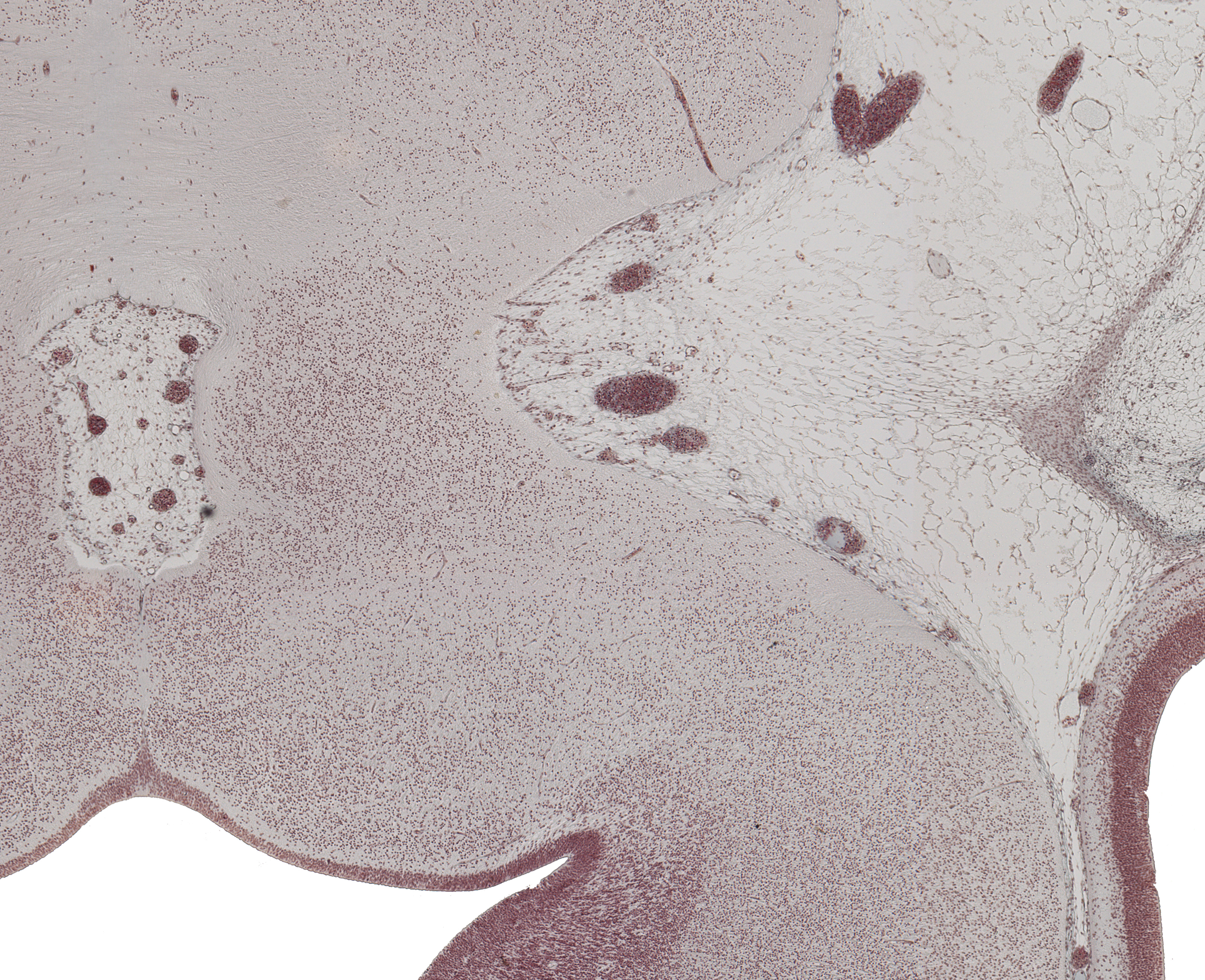 Basis Pedunculi Region and Edge of Interpeduncular Fossa
