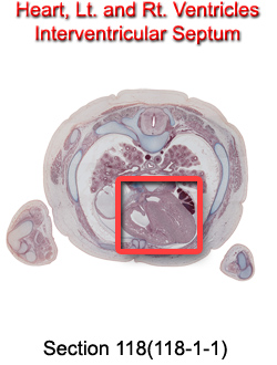 Heart, Lt. and Rt. Ventricles Inverventricular Septum