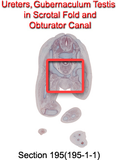 Ureter, Gubernaculum Testis in Scrotal Fold, and Obturator Canal