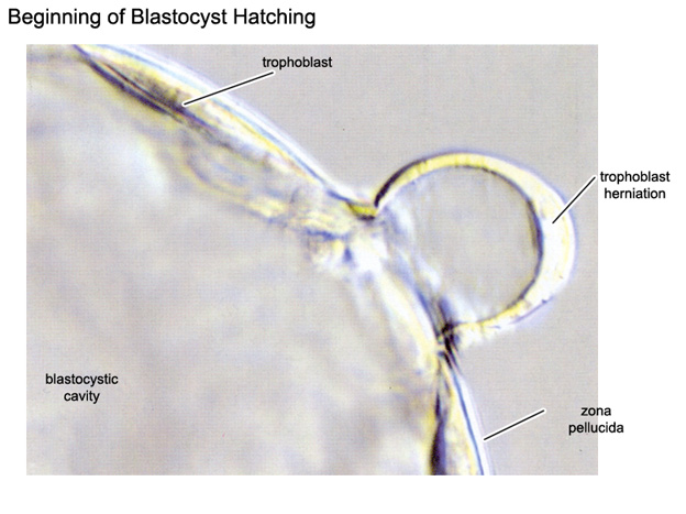 Trophoblast herniation