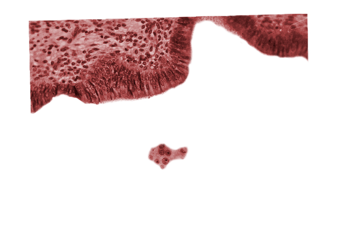 endometrial (uterine) epithelium, endometrial (uterine) stroma, tangentially cut mural trophoblast, uterine cavity