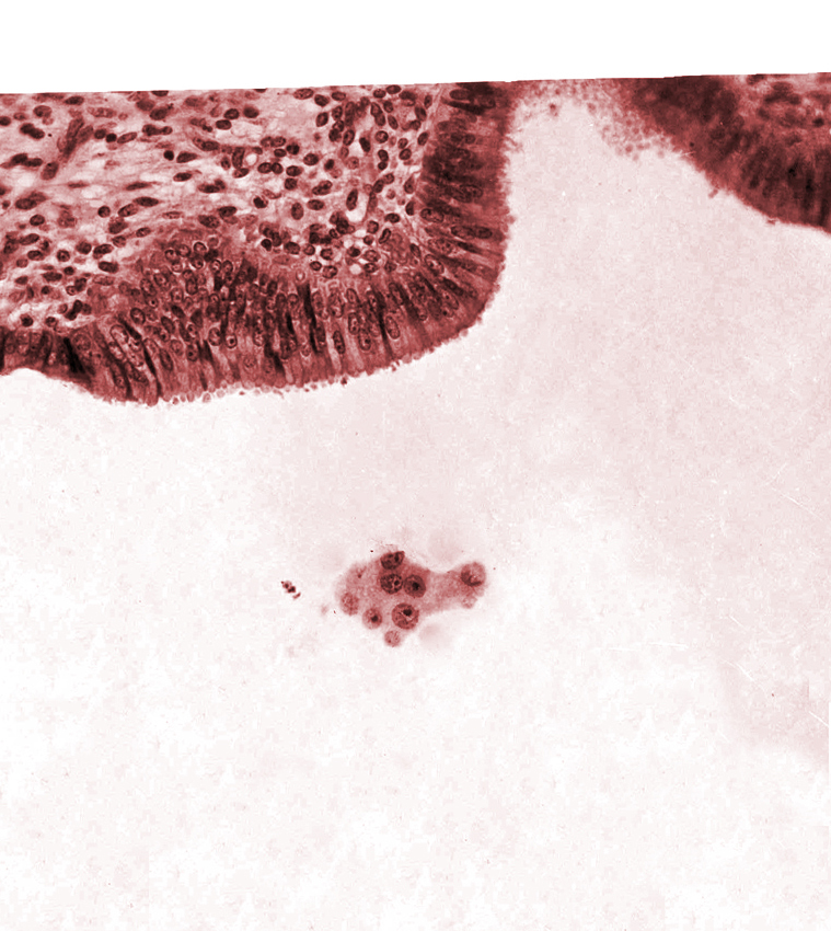 endometrial (uterine) epithelium, endometrial (uterine) stroma, tangentially cut mural trophoblast, uterine cavity