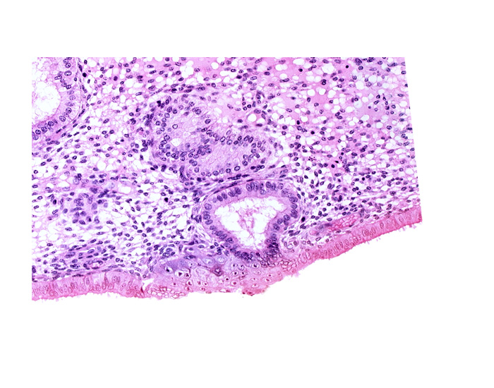 disrupted endometrial epithelium, edematous endometrial stroma (decidua), endometrial epithelium, endometrial gland, solid syncytiotrophoblast