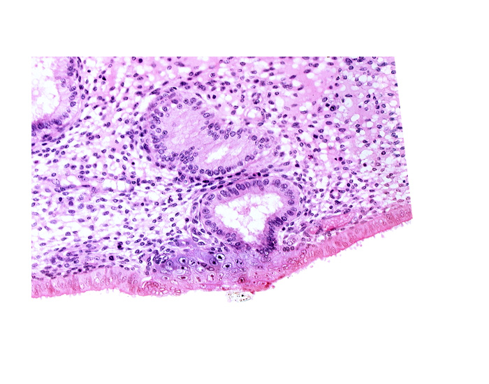 disrupted endometrial epithelium, edematous endometrial stroma (decidua), endometrial gland, solid syncytiotrophoblast, syncytiotrophoblast / decidua interface