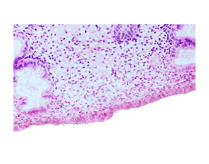 disrupted endometrial epithelium, endometrial epithelium, lumen of endometrial gland