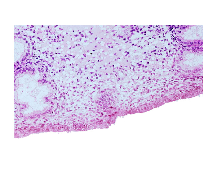 disrupted endometrial epithelium, endometrial epithelium, endometrial gland, lumen of endometrial gland