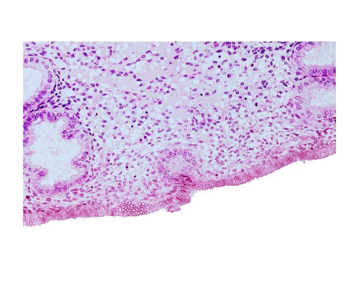 disrupted endometrial epithelium, edematous endometrial stroma (decidua), endometrial epithelium, endometrial gland