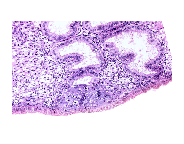 cytotrophoblast, edge of endometrial gland, endometrial epithelium, endometrial gland, endometrial sinusoid, solid syncytiotrophoblast, uterine cavity