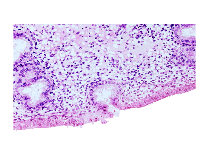 disrupted endometrial epithelium, edematous endometrial stroma (decidua), endometrial epithelium, lumen of endometrial gland