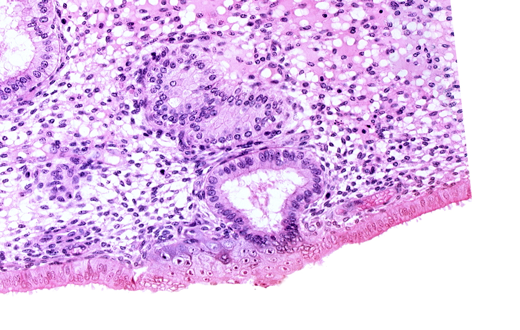 disrupted endometrial epithelium, edematous endometrial stroma (decidua), endometrial epithelium, endometrial gland, solid syncytiotrophoblast